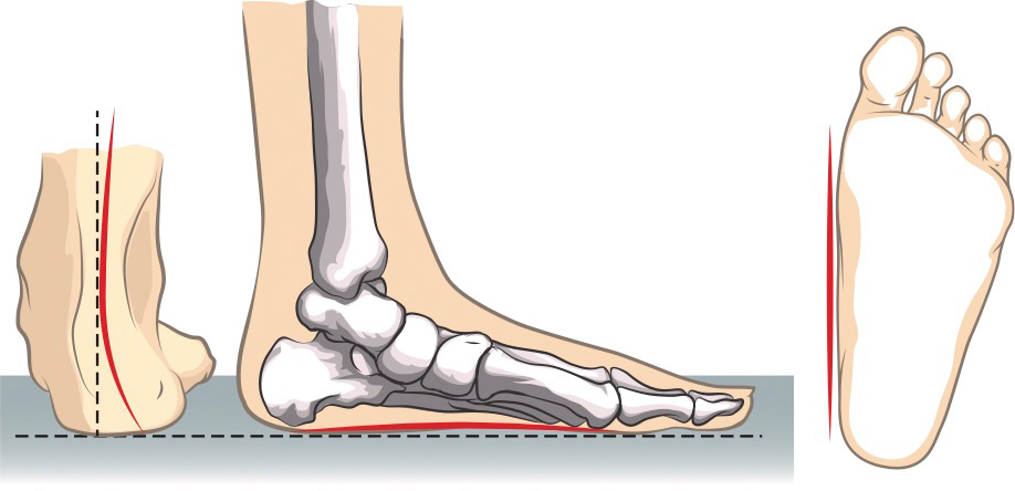 Flat Feet
